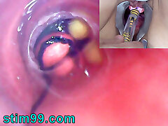 Mature Female, Peehole Endoscope Camera in Bladder with Balls