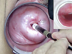 A endoscope chinese camera is inserted in the cervix to watch inside the uterus.