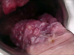 Inside  view of my extreme Prolapse shitpipe