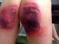 Severe Corporal Punishment