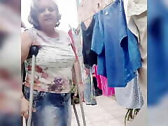 hip amputee